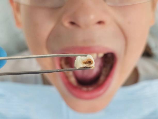Best Emergency Wisdom Teeth Removal in Trezevant, TN